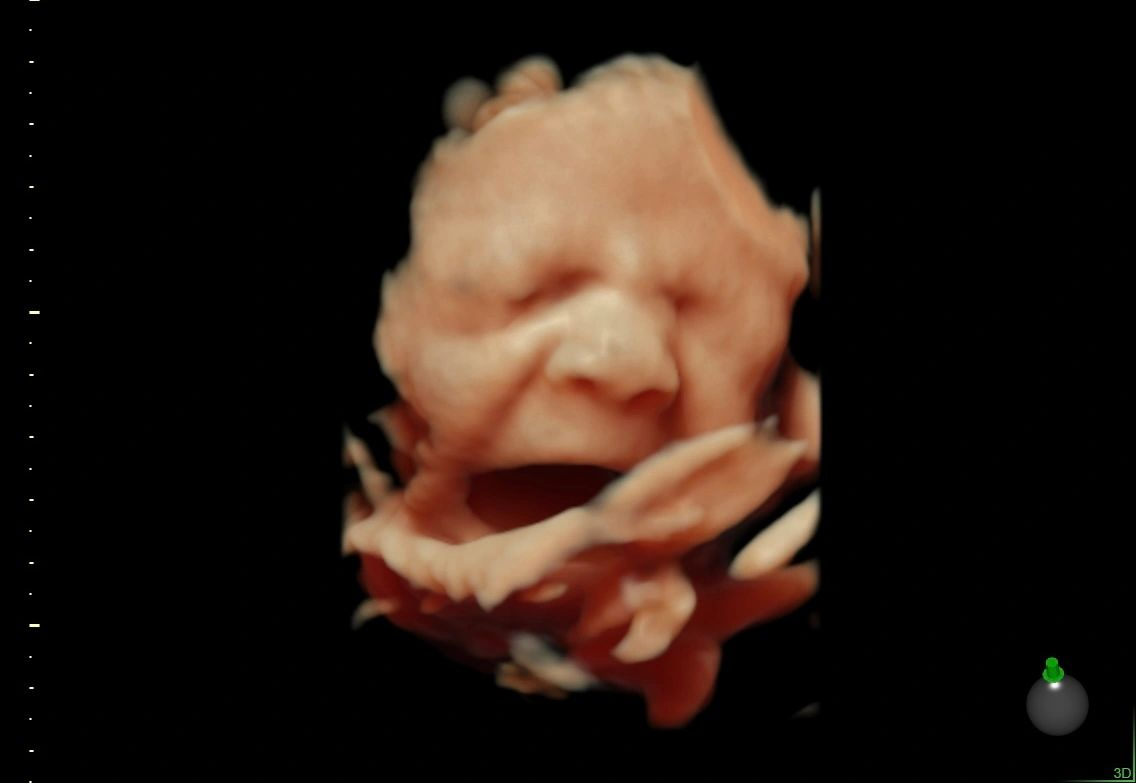 4D ultrasound showing a baby's face