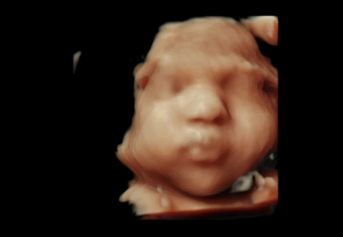 4D ultrasound close-up showing a baby’s cheeks and nose.