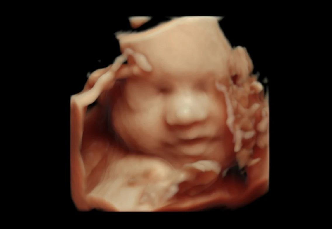 4D ultrasound close-up of a baby’s face with a hand above the forehead.