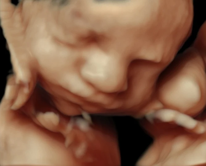 Close-up 3D ultrasound image of a baby facing downward.