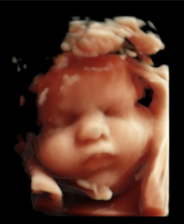3D ultrasound image showing a baby's face with a hand raised above the head.