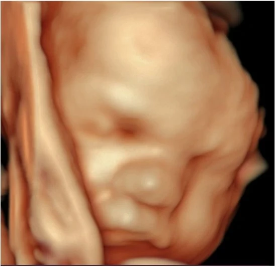 4D ultrasound showing a baby’s face tilted downward.