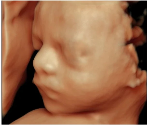 4D ultrasound showing a baby’s face turned to the side with a hand beside the head.