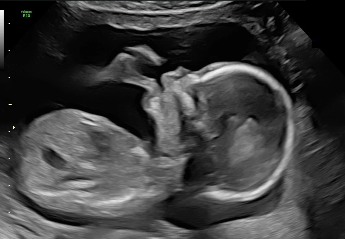 A black-and-white 2D ultrasound showing a baby in profile with a hand near the face.